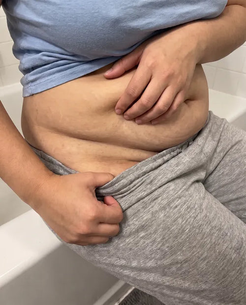 After: the same lower belly fold much calmer, a faint pink line left
