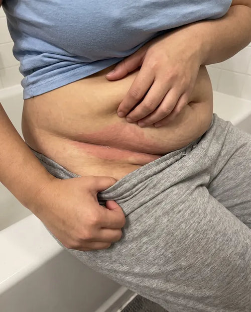 Before: an irritated red band inside the deep lower belly fold above grey leggings