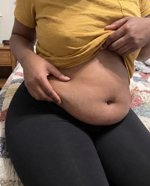 After: the same belly fold calm and close to her own skin tone, a faint trace left