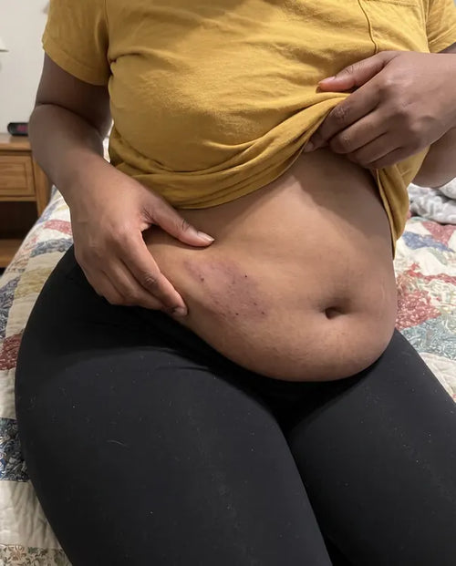 Before: a dark, irritated line in the belly fold of a woman lifting her mustard T-shirt