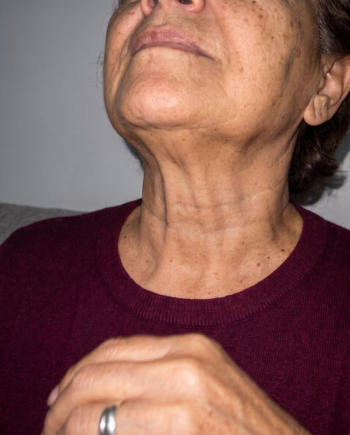 After: the same neck creases much calmer, faint pink still visible