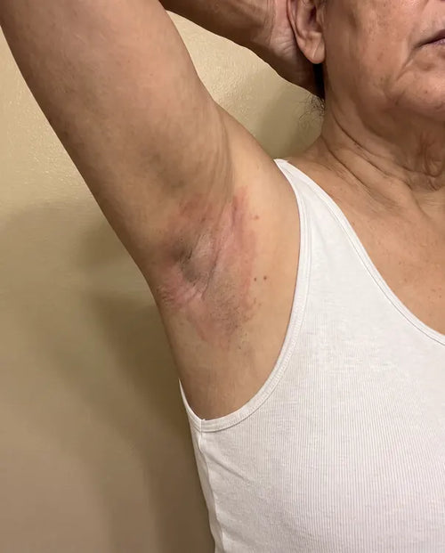 Before: an irritated red patch in the underarm of a woman in a white tank top, arm raised