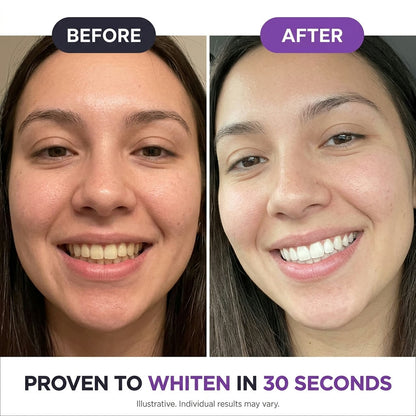 Before and after whitening with PurpleSnow Gels